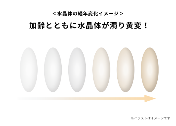 水晶体の経年変化イメージ：加齢とともに水晶体が濁り黄変！